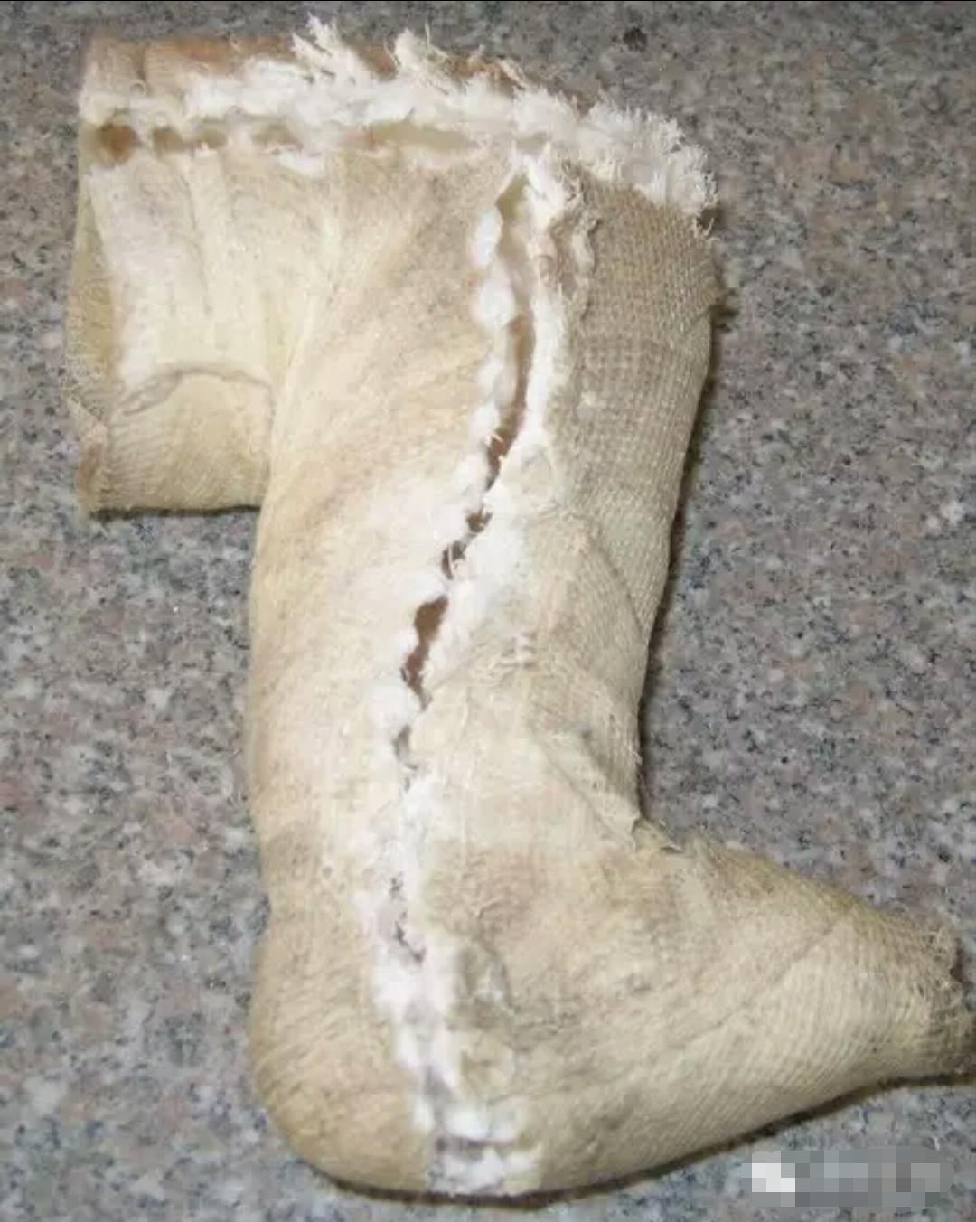 先天性马蹄足内翻能够治愈吗,马蹄足和足内翻是一样的吗