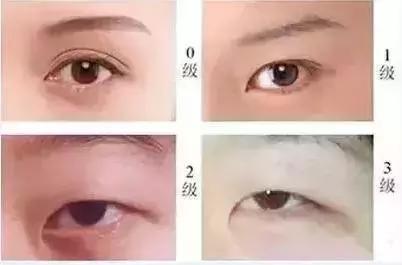 什么人合适开内眼角和外眼角,每个人都合适开外眼角吗