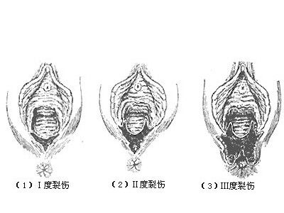 医生能够不拆线吗,医生能够不拔指甲吗