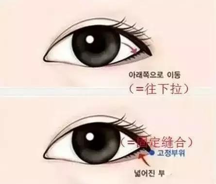 什么人合适开内眼角和外眼角,每个人都合适开外眼角吗