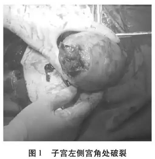 输卵管切除并发症,输卵管妊娠手术风险