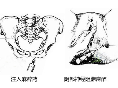 会阴切开术,会阴切开术指征是什么