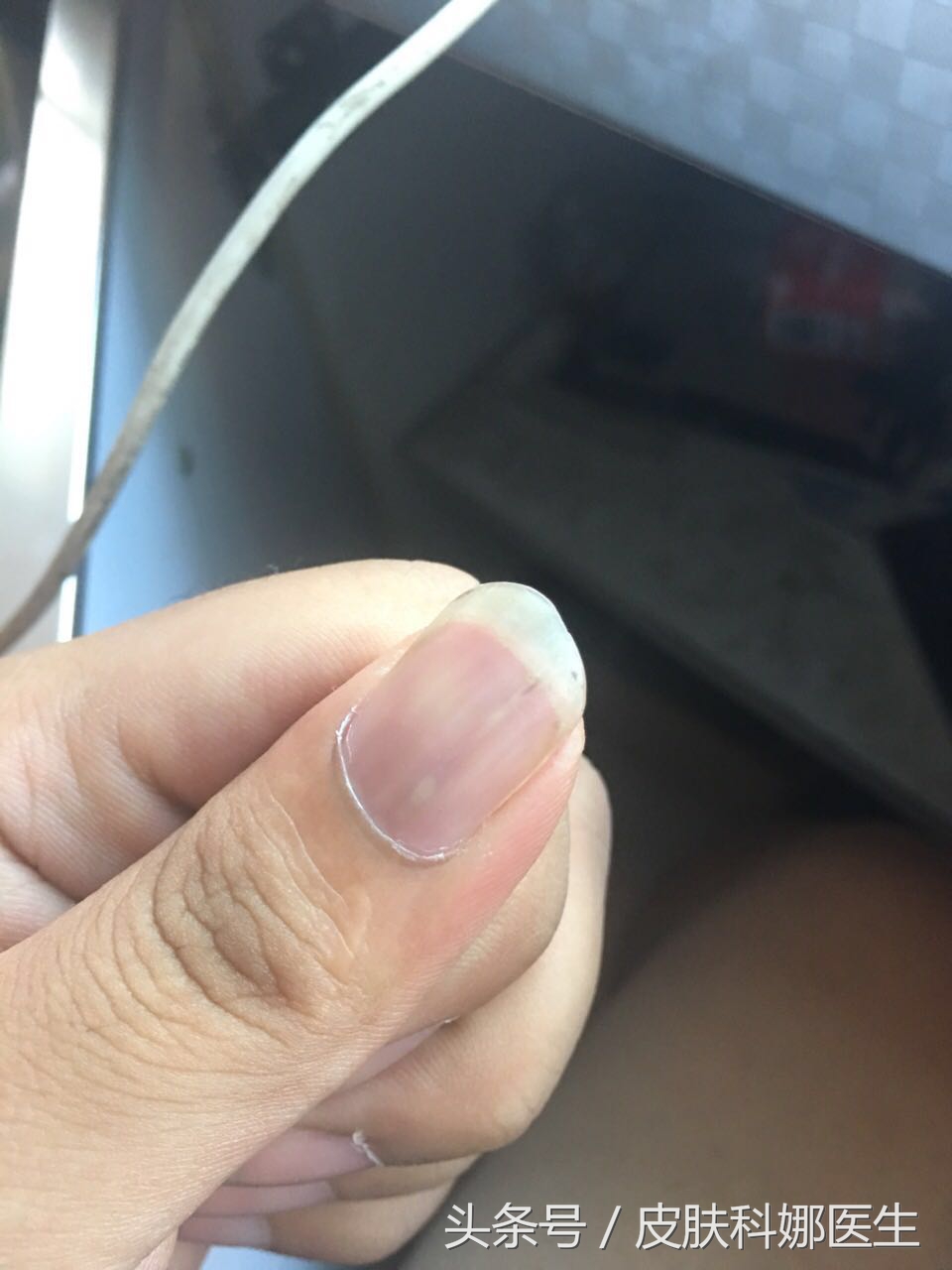 指甲里像扎了竹签一样痛什么原因,指甲壳里扎刺又肿又痛