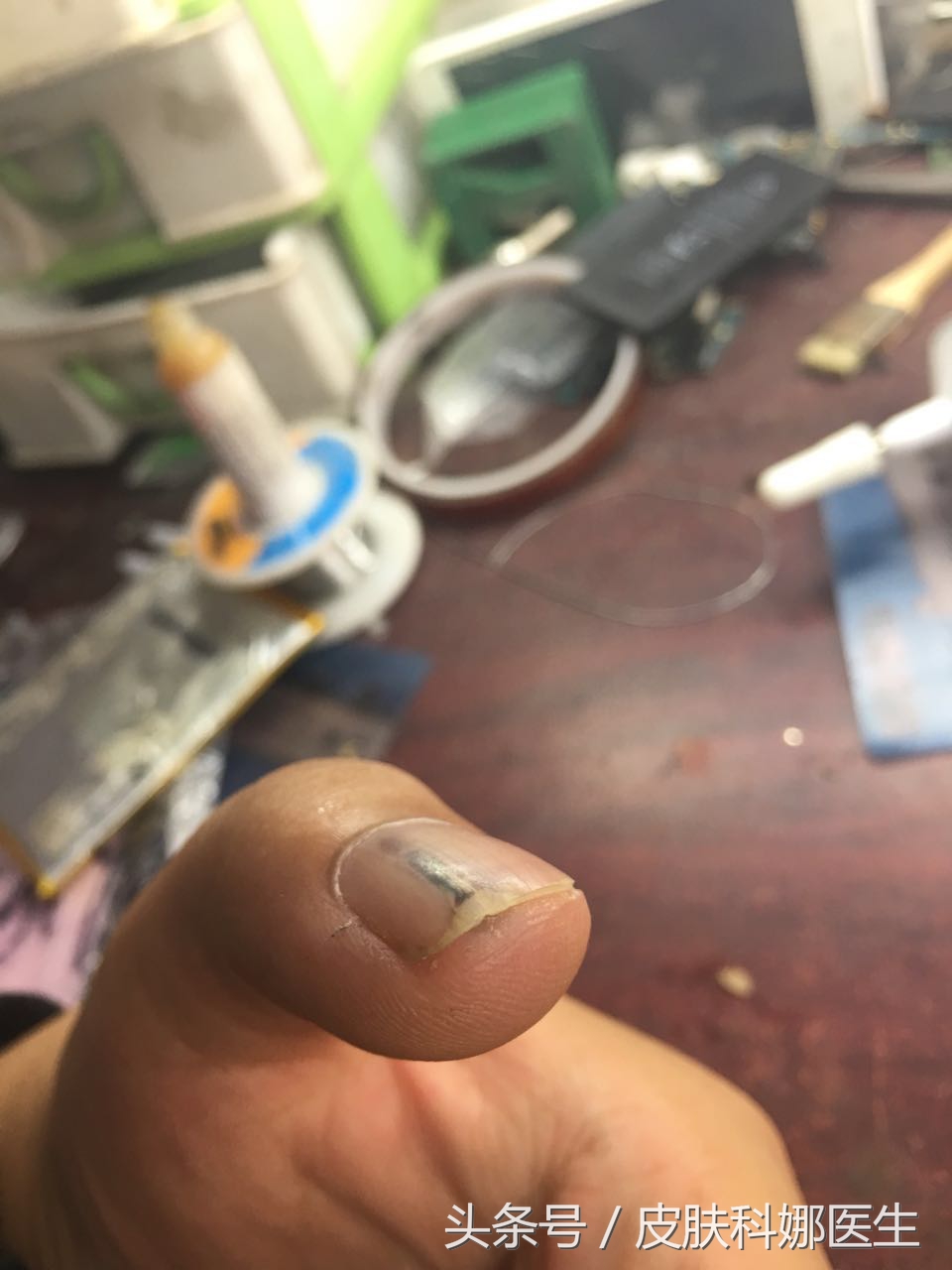 指甲里像扎了竹签一样痛什么原因,指甲壳里扎刺又肿又痛