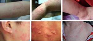 中医治荨麻疹能止痒吗,中医对荨麻疹有不同的治疗方法