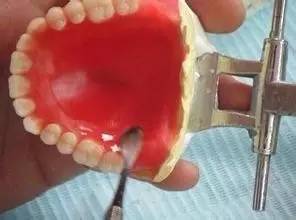 牙科镶牙全过程,口腔科普镶牙全过程图