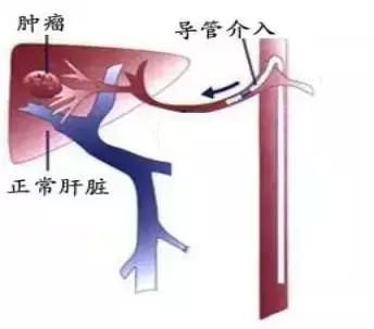协和肝外科赵海涛行家,赵海涛治胆道肿瘤