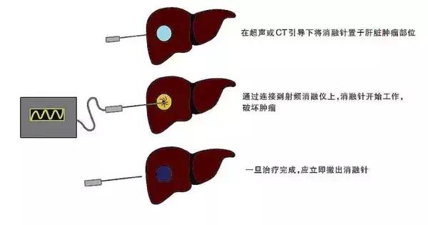 协和肝外科赵海涛行家,赵海涛治胆道肿瘤