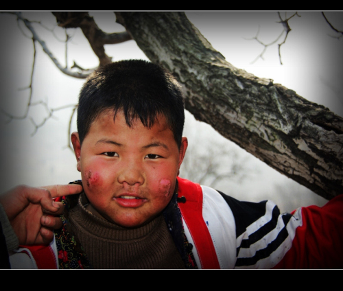 宝宝冬季冻伤,宝宝冻着了会导致低温吗