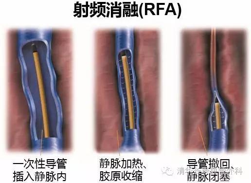 行家讲堂静脉曲张怎么治疗,静脉曲张微创射频闭合术
