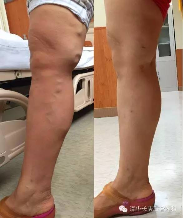 行家讲堂静脉曲张怎么治疗,静脉曲张微创射频闭合术