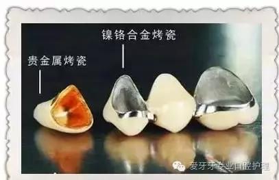 不同价格的牙冠区别在哪里,不同价格的烤瓷有区别吗