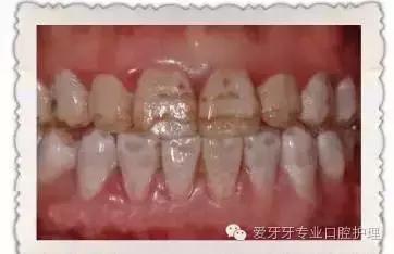 不同价格的牙冠区别在哪里,不同价格的烤瓷有区别吗