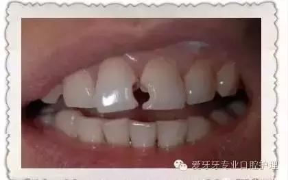 不同价格的牙冠区别在哪里,不同价格的烤瓷有区别吗