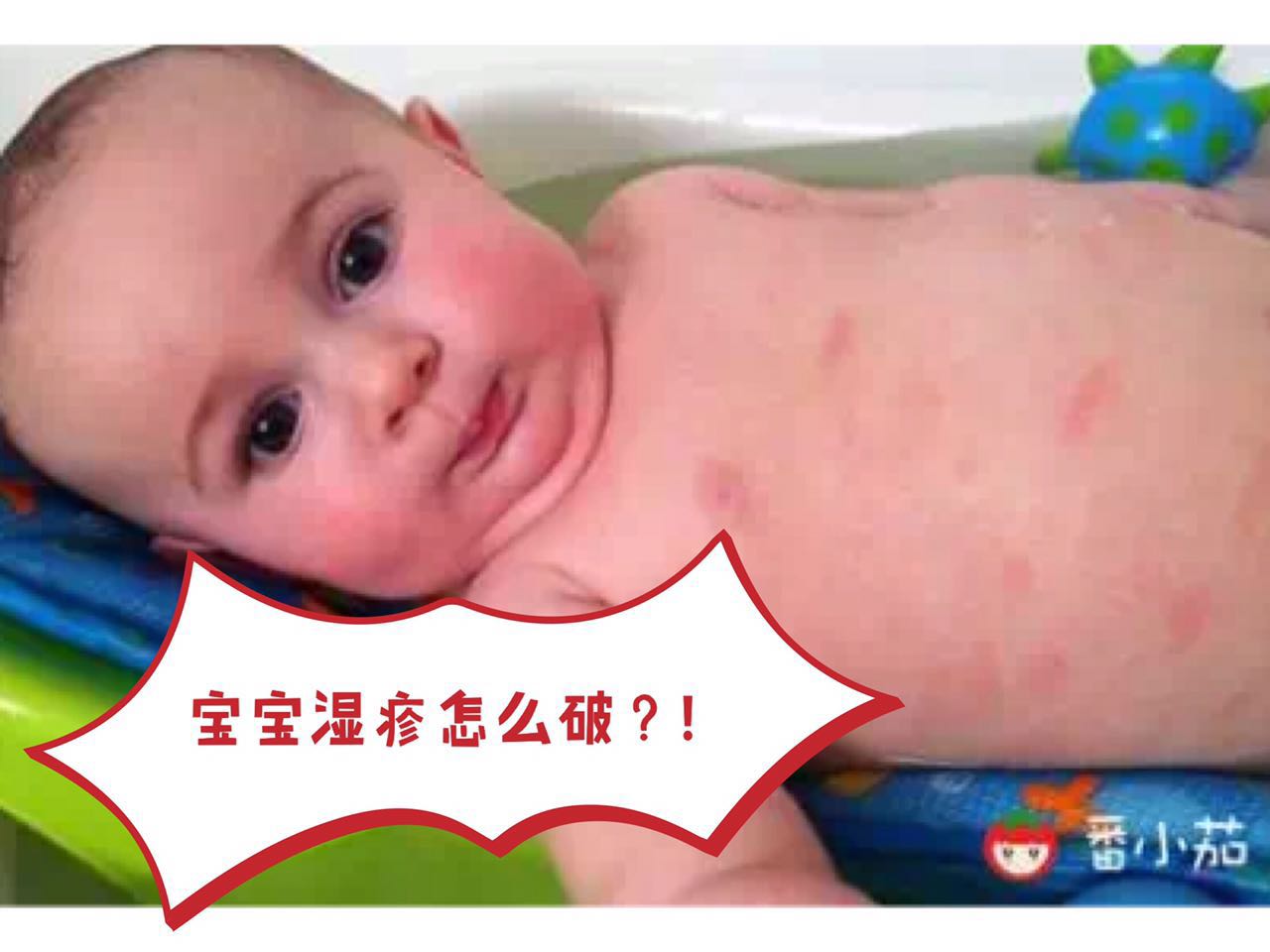 宝宝湿疹能够用激素药么,宝宝湿疹能够拿金银花水擦吗