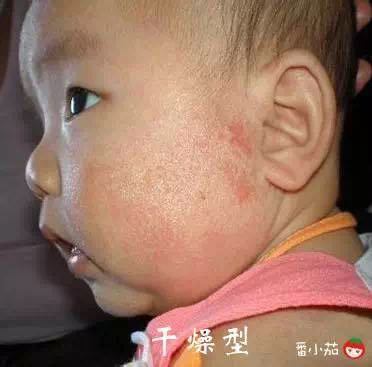 宝宝湿疹能够用激素药么,宝宝湿疹能够拿金银花水擦吗