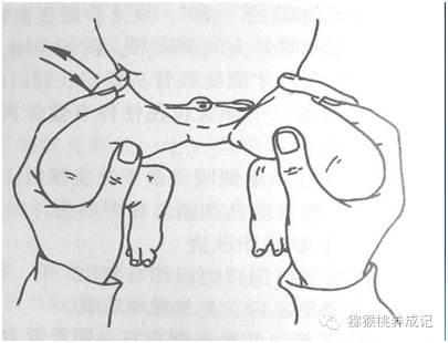大腿纹不对称图片大全,新生儿大腿皮纹不对称怎么办
