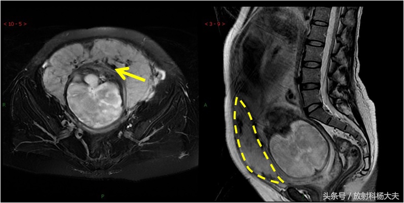 胎盘植入后还能生两胎吗,胎盘植入还能生2胎吗