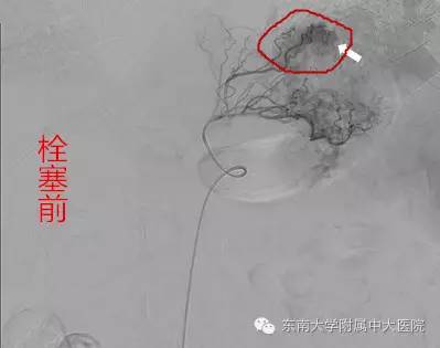 栓塞治疗有没有副功能,减肥后下肢静脉栓塞能改善吗