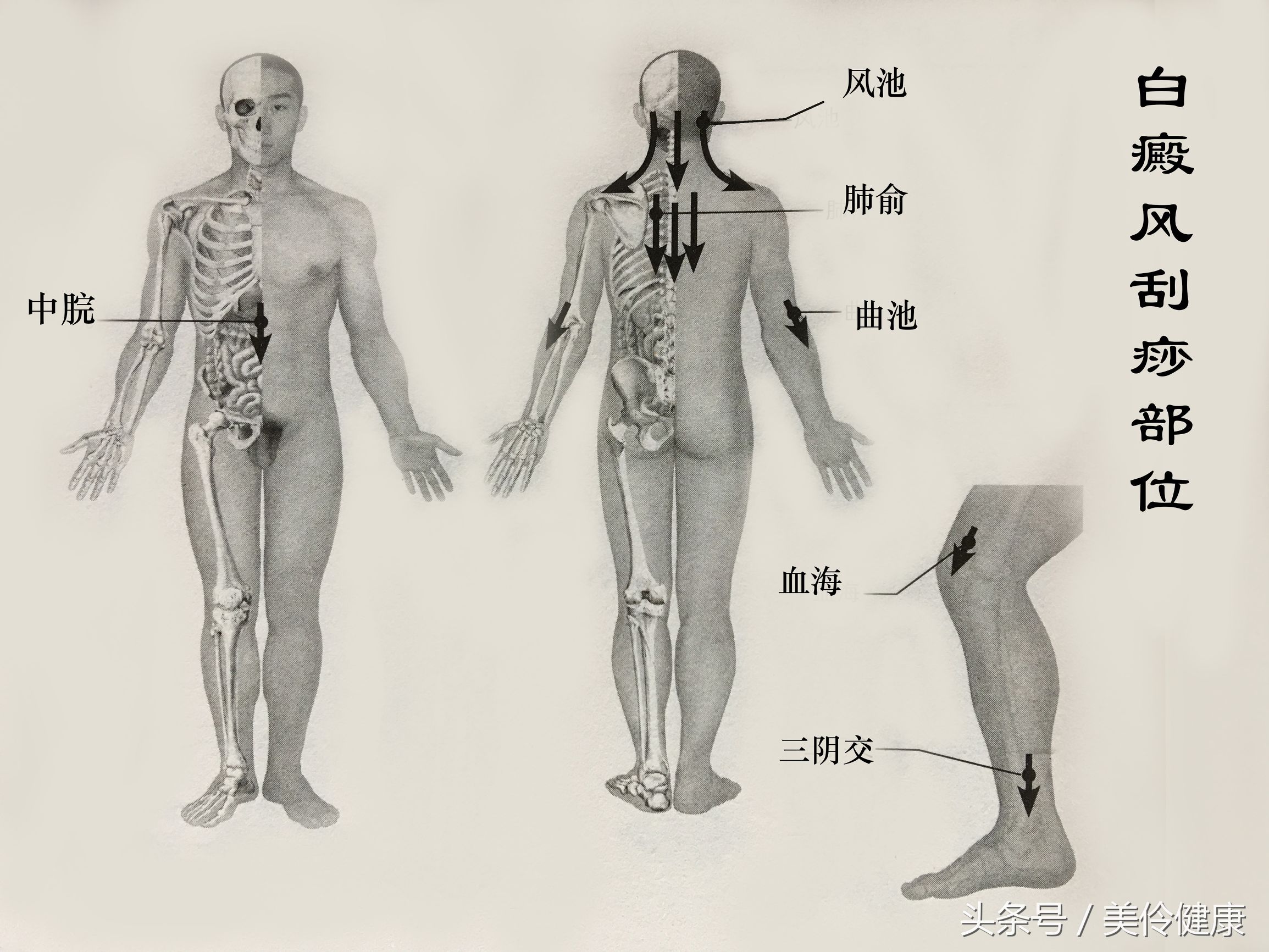白癜风治疗的刮痧法,刮痧刺血治疗白癜风