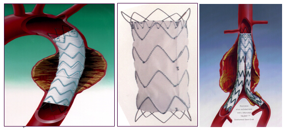 心血管支架多长时间更换,心血管球囊与支架的区别