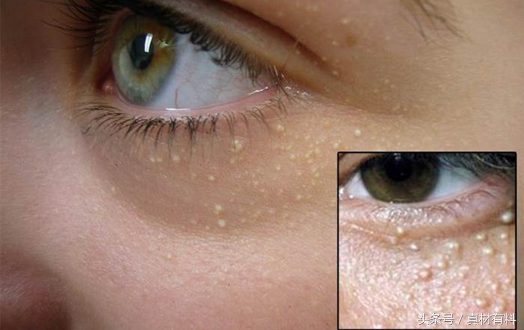 为什么会有脂肪粒怎么去除,脂肪粒是什么原因怎么去除