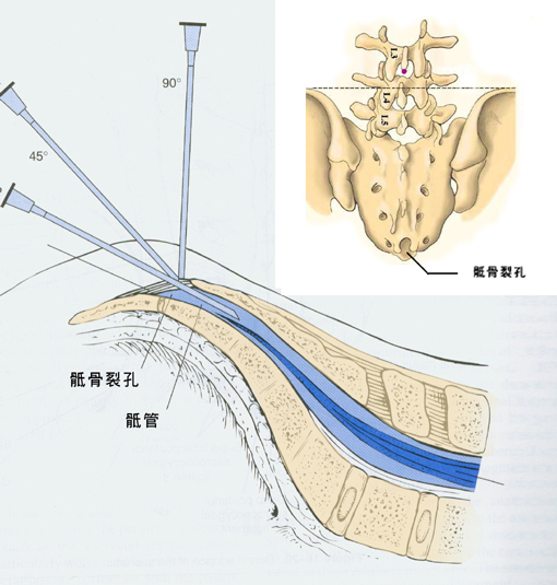 高龄老年腰腿痛患者能够尝试的一种无创疗法