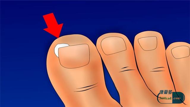 甲沟炎破坏甲床手术需要多少钱,甲沟炎手术怎样治疗能彻底根除