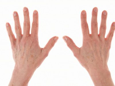 湿疹的病因与发病机制及临床表现,皲裂性湿疹的病因能够查到吗