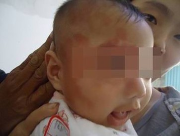 宝宝面部胎记,宝宝各种胎记对照表