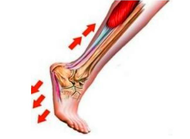 足底筋膜炎康复训练,脚筋膜炎运动康复训练