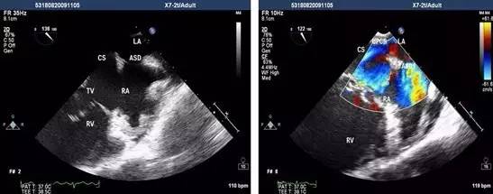 做房颤手术之前一定要做食道镜吗,房颤需要做食道超声吗