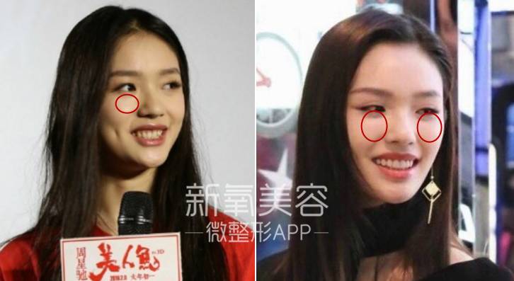 林允整牙却像整容？她是真的又整了啊！