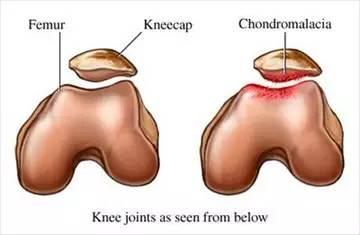 髌骨软化症最佳的治疗方法,夹球能够锻炼髌骨软化症吗