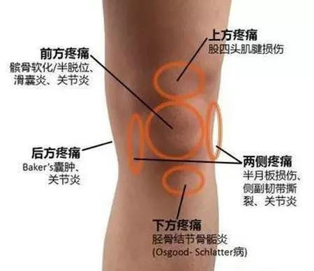 髌骨软化症最佳的治疗方法,夹球能够锻炼髌骨软化症吗
