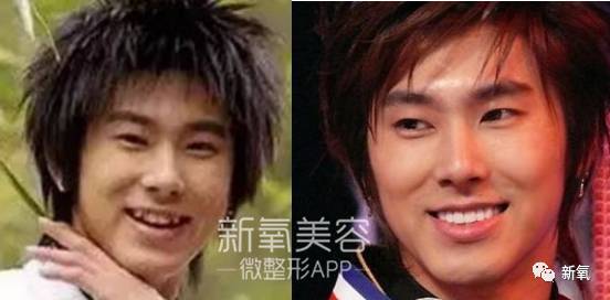 林允整牙却像整容？她是真的又整了啊！