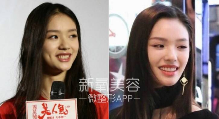 林允整牙却像整容？她是真的又整了啊！