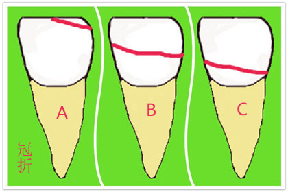 牙齿骨折后能自然愈合吗,骨折能够彻底痊愈吗