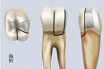 牙齿骨折后能自然愈合吗,骨折能够彻底痊愈吗