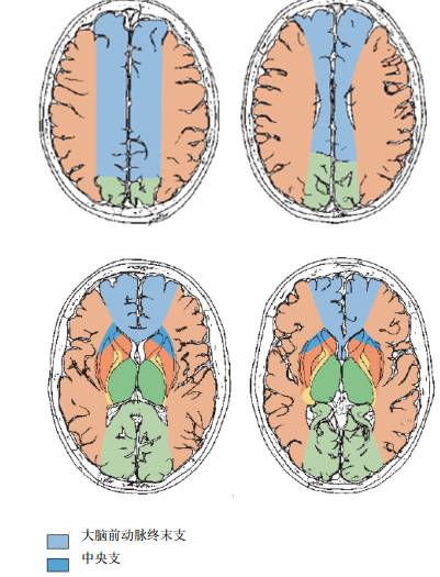 大脑前动脉梗死属于小动脉梗死吗,左侧大脑中动脉闭塞大面积梗死