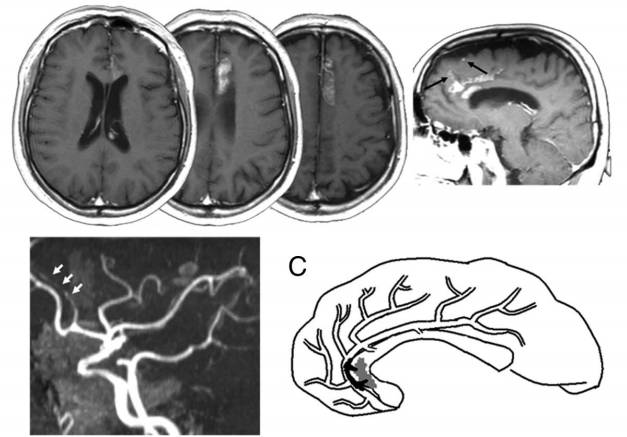 大脑前动脉梗死属于小动脉梗死吗,左侧大脑中动脉闭塞大面积梗死