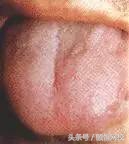 中医舌诊图谱100例,靠谱中医史上最全高清舌诊图谱