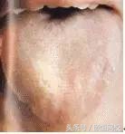 中医舌诊图谱100例,靠谱中医史上最全高清舌诊图谱