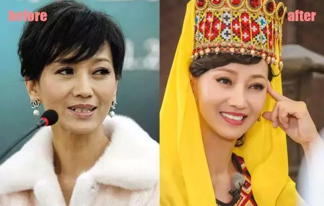 整牙=整容？看杨幂、刘涛、高圆圆为你亲身示范！