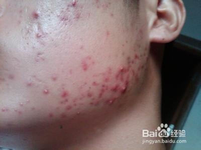 长痘痘怎么办快速消痘男士,长痘痘期间该吃什么能够消除痘痘