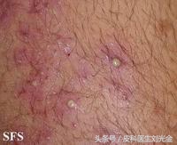 疮疖和毛囊炎的区别,毛囊炎和湿疹的区别