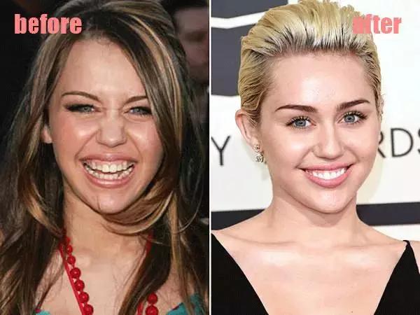 整牙=整容？看杨幂、刘涛、高圆圆为你亲身示范！