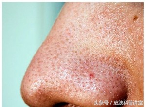 皮肤科医生毛孔粗大有黑头,黑头毛孔粗大看皮肤科有用吗