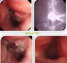 成都光动力治疗肿瘤行家有哪些,光动力治疗肿瘤的研究背景