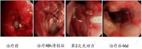 成都光动力治疗肿瘤行家有哪些,光动力治疗肿瘤的研究背景
